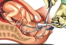 FORSEPS YARDIMI NEDİR?